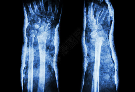 桡骨远端骨折 Colles 骨折 和石膏 正面和侧面半径射线保健解剖学骨骼腕骨诊断x光夹板手腕图片
