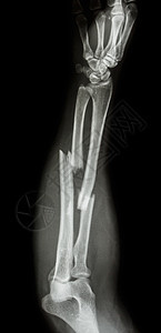 半径断裂轴和ulnar骨男人前臂外科电影考试情况医院射线骨科手腕图片