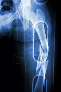 电影X光显示科明的股骨高骨头断裂轴事故解剖学卫生药品骨科手术医生保健病人疾病图片