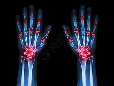 黑色背景的双手Gout 风湿多重关节炎卫生解剖学身体药品x光痛风放射科保健外科掌骨图片