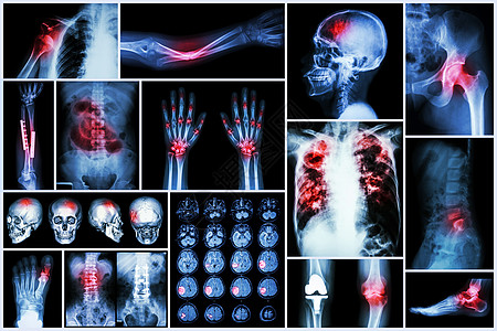 X-射线多种疾病 中风 脑血管意外 脑血管病 肺结核 骨折 肩关节脱位 痛风 类风湿性关节炎 脊椎病 骨关节炎 肠梗阻图片