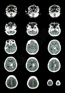 脑部c的CT扫描光谱成像仪情况解剖学卫生疾病诊断手术射线医院调查男人图片