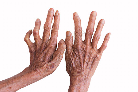 被白背景孤立的麻风病人的手图片