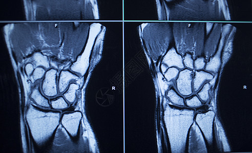MRI扫描测试结果 手腕受伤医院疾病韧带外科医生检测技术黑色保健x光图片