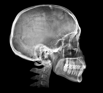 人类头骨X光图像诊所解剖学创伤考试药品疾病医生科学脖子身体图片