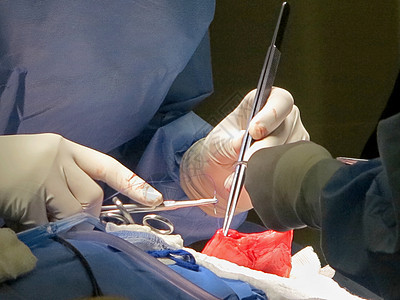 胃部抽取狮子切口手术手套疾病器官管子手指针脚医生图片