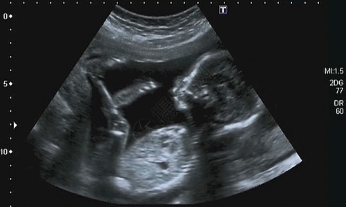 对四月四月胎儿的超声波分析机器女性生活射线子宫医院居住孩子考试乐器图片