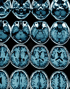 MRI 用于诊断的大脑扫描图像图片