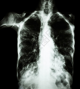 肺肺结核薄膜胸透 由于Mycobactium结核病感染 间歇性渗入两个肺部解剖学感染药品x射线疾病肺泡传播诊断躯干结核病图片