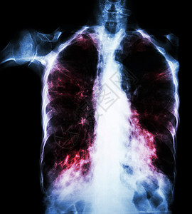 肺肺结核薄膜胸透 由于Mycobactium结核病感染 间歇性渗入两个肺部药品纤维化男人细菌蓝色x射线传播结核病扫描诊断图片