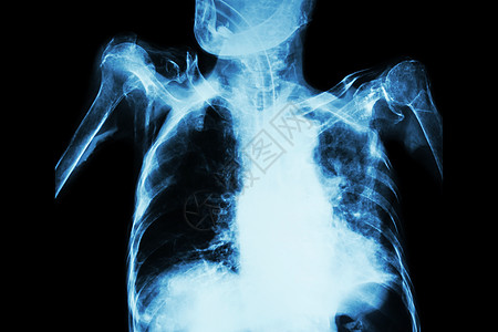 急性呼吸系统衰竭旧病人的乳胸X光片显示肺动脉和通过内径切耳管透入肺部并同时渗入内侧胃管的肺道肺结核胸部放射科肺泡解剖学管子结核插图片