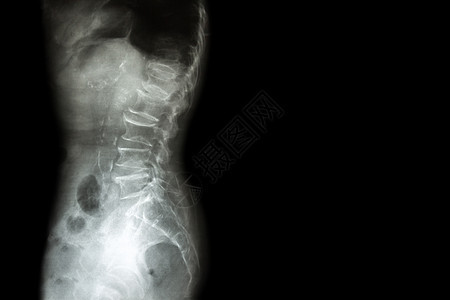 脊椎病 脊椎滑脱 电影 x 射线腰骶脊柱显示脊柱塌陷 椎间盘空间减少 骨刺形成 侧面 侧视图 和右侧空白区域骨质扫描疼痛腰部疾病图片