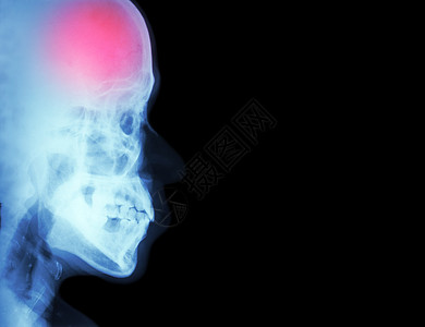 Stroke脑血管事故胶片X射线头颅横向中风和右侧空白区域医疗和科学及保健背景病人增值税医院扫描x射线偏头痛医生疼痛神经x光图片