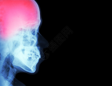 Stroke脑血管事故胶片X射线头颅横向中风和右侧空白区域医疗和科学及保健背景创伤神经病大脑骨骼疼痛疾病增值税学家男人神经图片