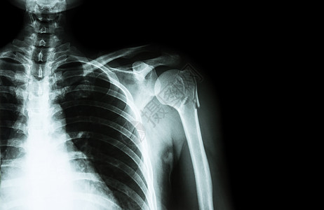 Humerus颈部断裂臂骨薄片X光左肩和右侧空白区手术男人医生科学x射线骨科病人诊断解剖学扫描图片