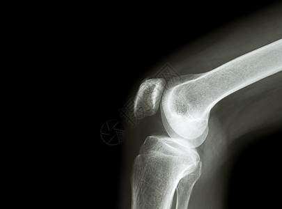 拍摄带关节炎 痛风 类风湿性关节炎 化脓性关节炎 骨关节炎膝关节 的 X 射线膝关节和左侧空白区域骨科扭伤骨骼扫描股骨病人手术医图片