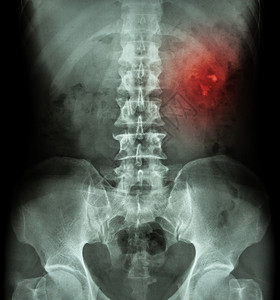 肾结石 肾结石 肾结石 拍片 X 光 KUB 肾输尿管膀胱 显示左肾结石疾病解剖学肾脏腰部骨盆医生椎骨外科扫描尿液图片