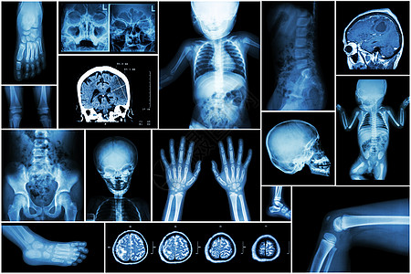 儿童身体多部位及多种疾病 中风 脑瘤 类风湿性关节炎 鼻窦炎 痛风性关节炎等 颅骨胸部肺心脏脊柱手臂手骨盆腿膝足 X光检查核磁共图片
