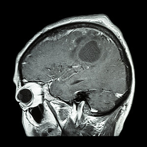 脑肿瘤的大脑胶片 MRI 矢状面 侧视图 侧视图 医疗 保健 科学背景中风医院外科核磁共振癌症病人颅骨扫描谐振疼痛图片