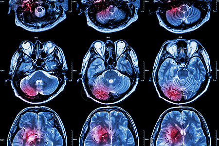 大脑 中风 脑肿瘤 脑梗塞 脑出血 的胶片 MRI 磁共振成像 医学 保健 科学背景 大脑横截面图片