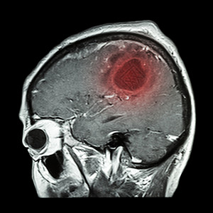 脑肿瘤的大脑胶片 MRI 矢状面 侧视图 侧视图 医疗 保健 科学背景x光疼痛解剖学谐振x射线中风诊断疾病电脑颅骨图片