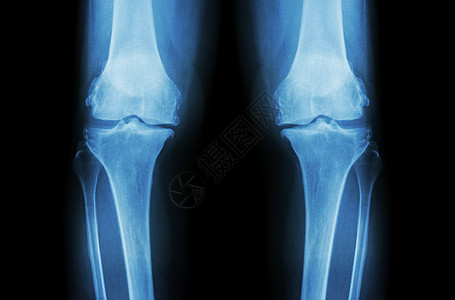 膝骨关节炎 OA 膝 双膝 X 光片 前视图 显示关节间隙狭窄 关节软骨丢失 骨赘 软骨下硬化大腿科学骨科疗法整骨外科诊断医院药图片