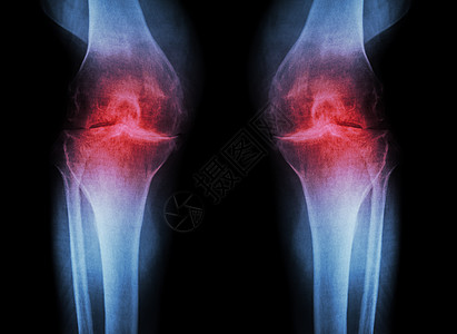 骨关节炎膝关节 OA 膝关节 膝关节关节炎的双膝 X 光片 膝关节间隙狭窄 医学和科学背景骨科股骨大腿疾病外科诊断放射科手术胫骨图片