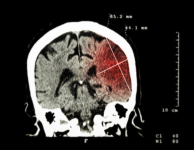 左半球的脑进卵化学中风大脑CT扫描 医学和科学背景以及手术疾病x射线医生核磁共振电脑学家诊断放射科神经病图片
