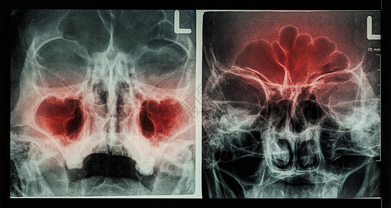 胶片 X 射线鼻旁窦 显示上颌窦 左图 额窦 右图 的鼻窦炎扫描药品医生放射科疼痛疾病医院病人鼻子手术图片