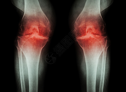 骨关节炎膝关节 OA 膝关节 膝关节关节炎的双膝 X 光片 膝关节间隙狭窄 医学和科学背景解剖学诊断股骨医院扫描x射线身体疗法膝图片