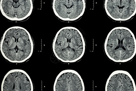 大脑 CT 扫描显示正常大脑 神经学背景 大脑 CT 扫描显示正常大脑 神经学背景图片