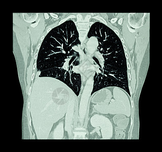 肺癌胸部和腹部CT扫描 显示右肺癌科隆飞机手术隔膜躯干外科电影诊断电脑医院考试解剖学图片