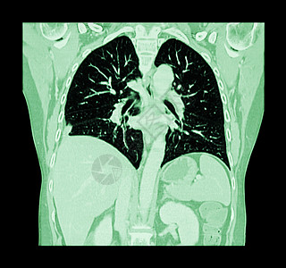 肺癌胸部和腹部CT扫描 显示右肺癌科隆飞机x光手术医生调查主动脉躯干外科断层医院考试图片