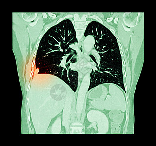 肺癌胸部和腹部CT扫描 显示右肺癌科隆飞机病人手术调查外科放射科癌症药品疾病电影主动脉图片
