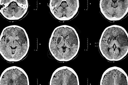 缺血性中风 脑CT显示左侧额颞顶叶脑梗塞 神经系统背景增值税药品诊断病人事故中风考试手术出血性医生图片