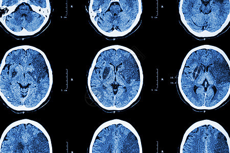 缺血性中风 脑CT显示左侧额颞顶叶脑梗塞 神经系统背景医生放射科疾病出血性中风情况断层大脑射线增值税图片
