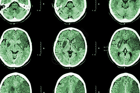 缺血性中风 脑CT显示左侧额颞顶叶脑梗塞 神经系统背景考试增值税事故梗死解剖学情况神经中风大脑疾病图片