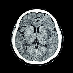 ct室脑部CT扫描 显示正常人的大脑CAT扫描事故疾病电脑断层创伤轴向中风手术神经电影背景