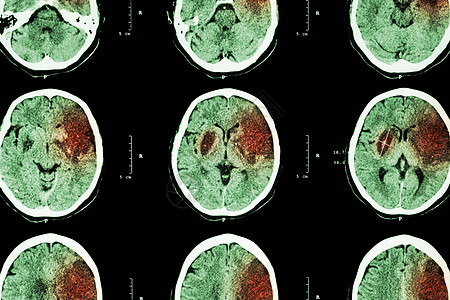 缺血性中风 脑CT显示左侧额颞顶叶脑梗塞 神经系统背景医生解剖学x光医院手术脑血管颅骨考试x射线疾病图片