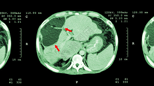 上腹部CT扫描 肝脏显示异常质量肝癌脊柱手术病人癌症调查肝细胞身体放射科外科电影图片