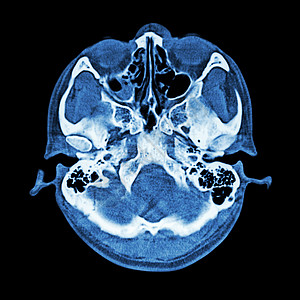 对大脑和头骨底部进行CT扫描骨窗疼痛疾病创伤病人增值税放射科窗户蓝色小脑调查图片