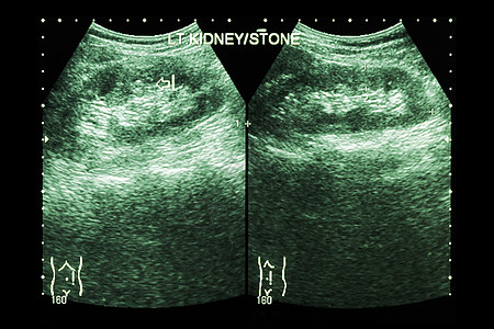 肾的超声波分析 显示左肾结石2张图象比较电影医生调查腹部放射科保健检查回声疾病石头图片
