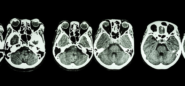 对大脑和头骨底部进行CT扫描显示眼睛结构 脑膜素瘤 小脑 脑等增值税外科中风卫生颅骨医院疾病断层诊断药品图片