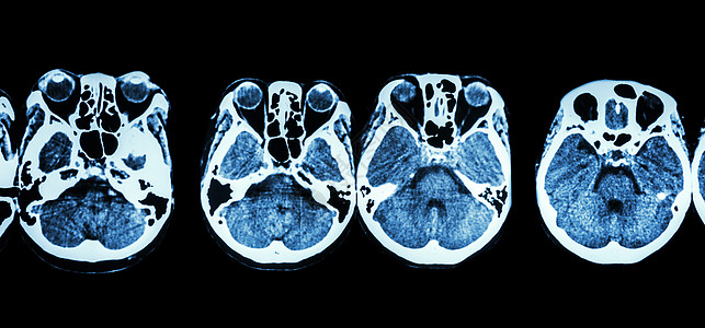 对大脑和头骨底部进行CT扫描显示眼睛结构 脑膜素瘤 小脑 脑等病人疾病颅骨x光电脑情况事故卫生脑血管神经图片
