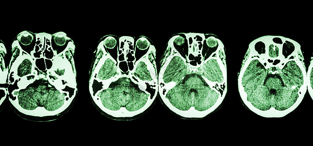 对大脑和头骨底部进行CT扫描显示眼睛结构 脑膜素瘤 小脑 脑等卫生放射科事故神经中风情况手术电影电脑断层图片