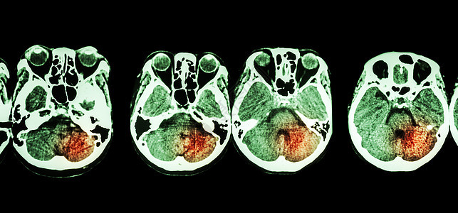 Stroke脑部CT扫描 头骨底部和刺探大脑诊断x射线疾病医生电脑情况小脑电影医院图片