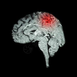 大脑和中风的磁共振成像MRI 医疗 科学和保健概念神经谐振扫描小脑神经病脑干梗死解剖学增值税事故图片