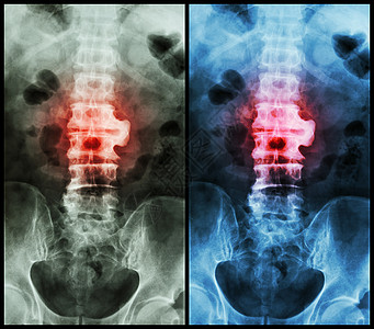 Spondylsis薄膜X射线脊椎 在L23时显示spondylsis病人x射线解剖学医生椎骨骶骨骨干躯干脊椎动物骨科图片