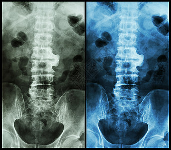 Spondylsis薄膜X射线脊椎 在L23时显示spondylsis脊椎动物x光强直性病人骨骼柱子扫描卫生脊柱放射科图片