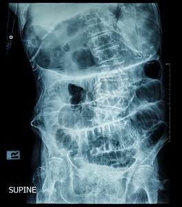 小肠阻塞胶片X射线腹部松露姿势 显示小肠和胃膨胀台阶模式便秘肠炎运河外科附着力梗阻卫生电影保健疼痛图片